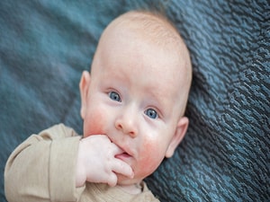 Study Identifies Skin Biomarkers That Predict Newborn Eczema Risk